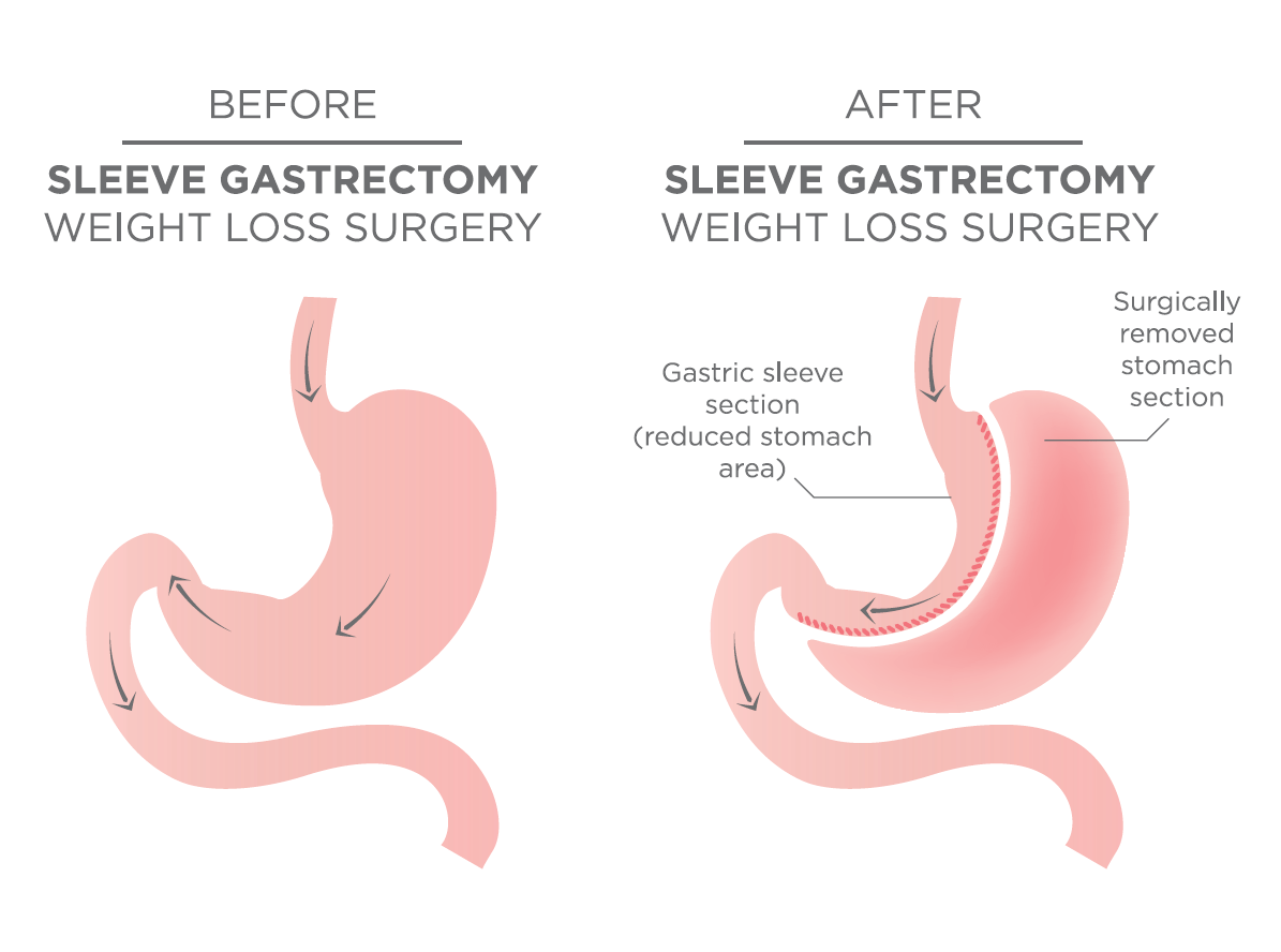 Sleeve Gastrectomy in Turkey