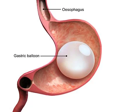 Gastric Balloon 101: Guide to Non-Surgical Weight Loss
