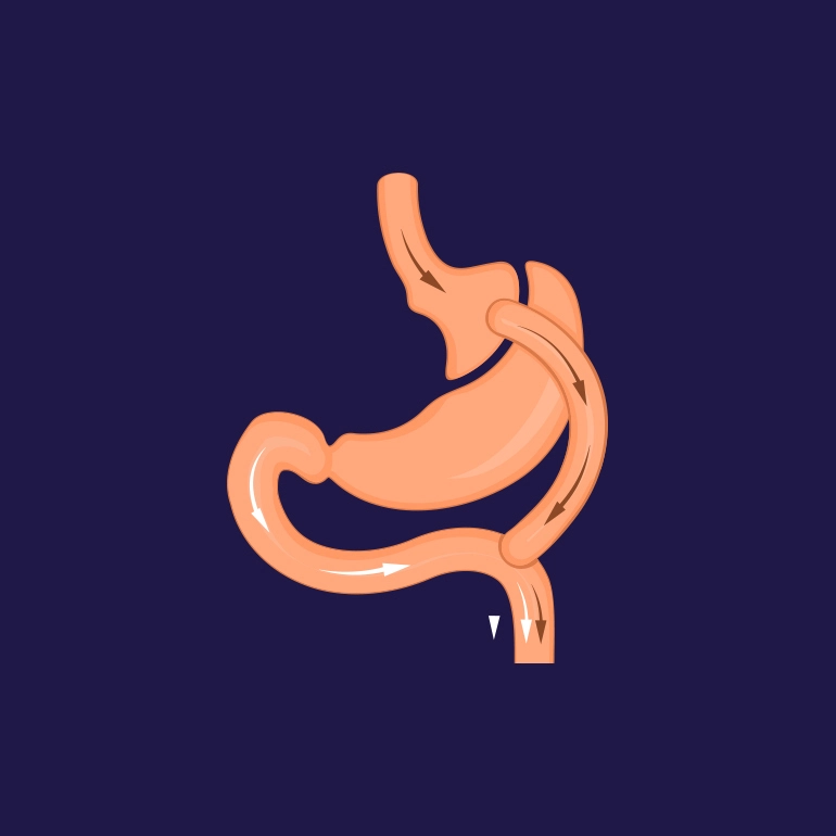 Gastric Bypass Recovery: What to Anticipate After the Surgery