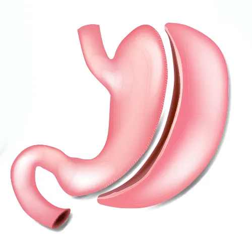 Pros, Cons, and Long-term Outcomes: Sleeve Gastrectomy