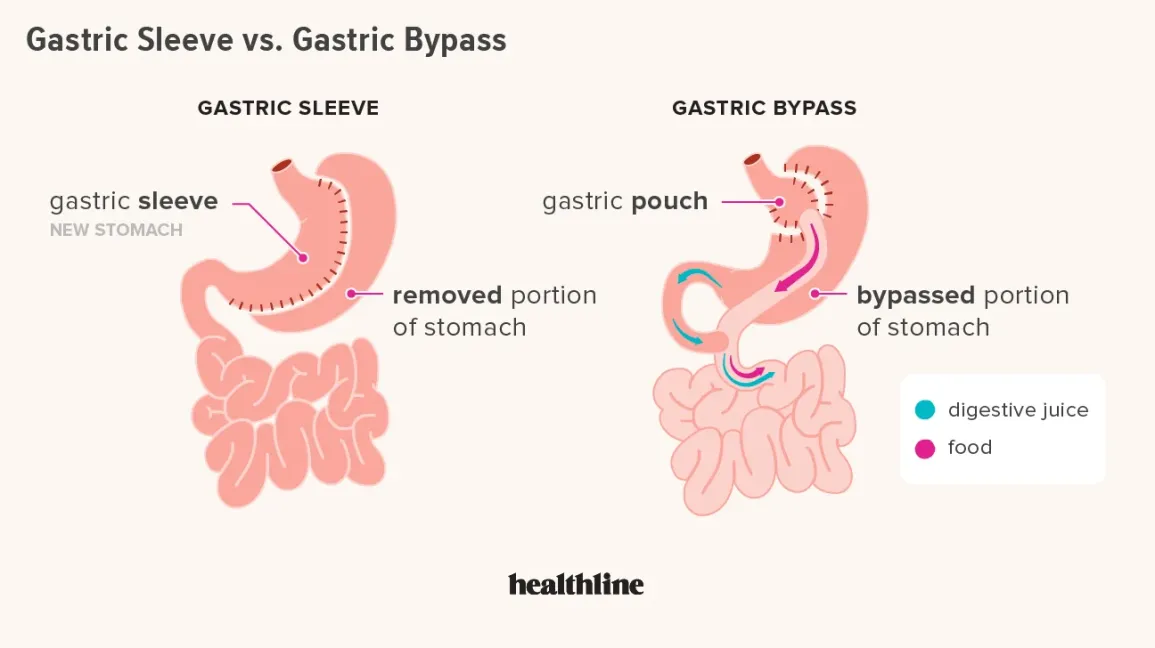 Gastric Sleeve vs. Gastric Bypass: 7 Key Factors to Consider for Changing Your Lifestyle