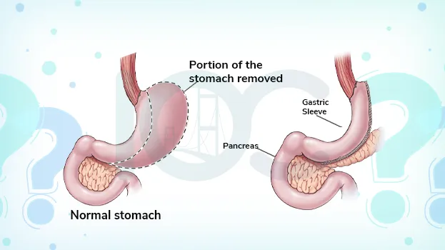 The True Cost of Sleeve Gastrectomy in Turkey: Affordable Solutions for Weight Loss