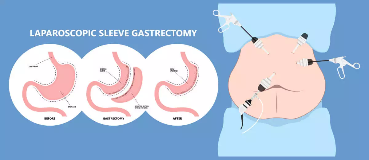 7 Key Insights into Sleeve Gastrectomy Surgery: What to Expect Before, During, and After